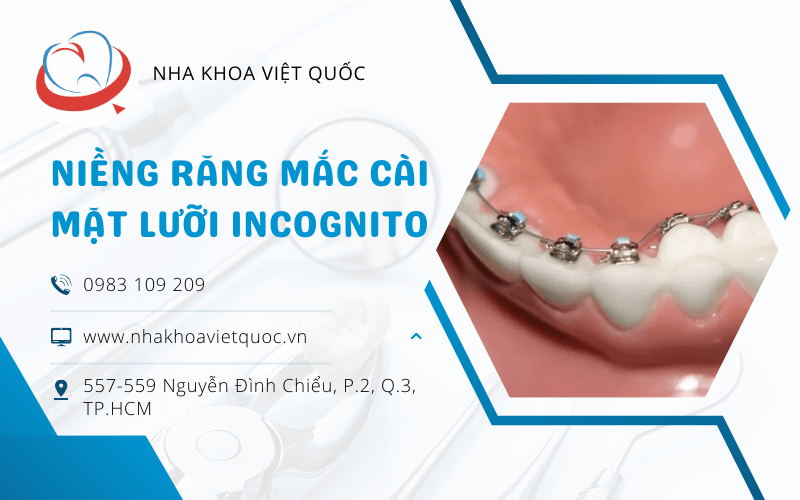 niềng răng mắc cài mặt lưỡi Incognito