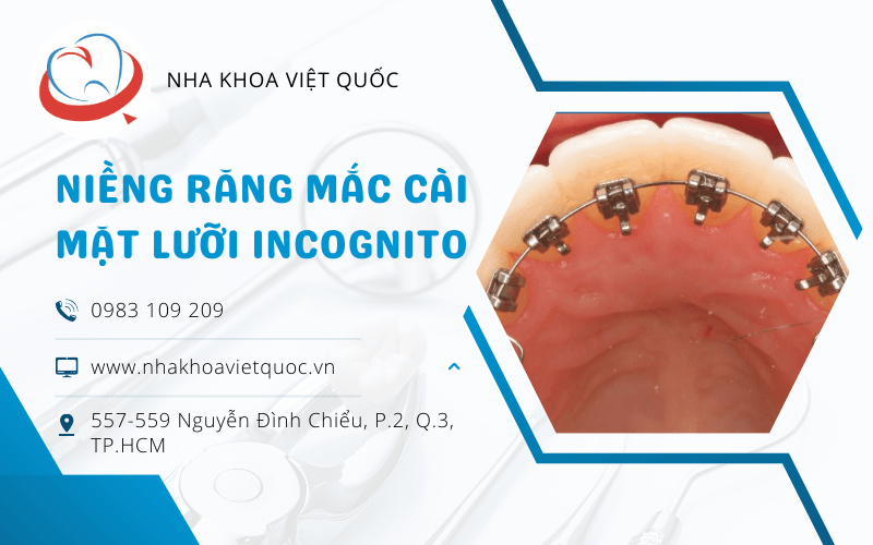 niềng răng mắc cài mặt lưỡi Incognito