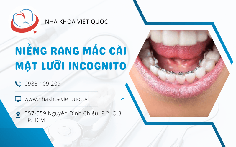 niềng răng mắc cài mặt lưỡi Incognito